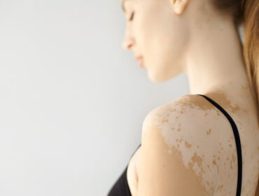 Vitiligo: Kako da na prirodan način poboljšate pigmentaciju kože