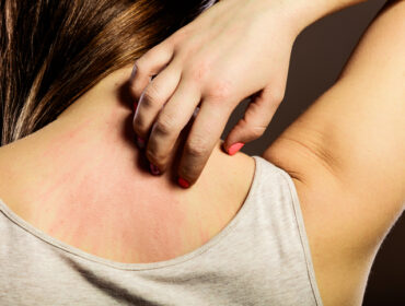 Simptomi i znaci na koži koji mogu ukazivati na ozbiljne bolesti