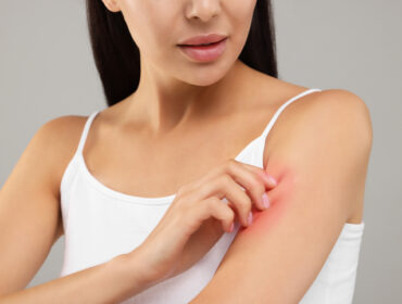 Infekcije kože: 5 kučnih lekova koji mogu da donesu olakšanje