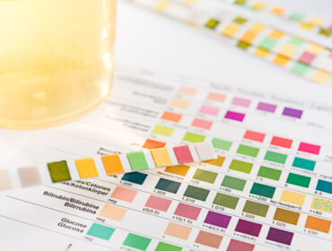 Saznajte kako boja urina može da otkrije određene zdravstvene poremećajte
