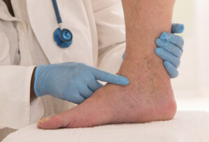 11 simptoma slabe cirkulacije u nogama i stopalima - kako ih prepoznati?